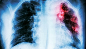 Covid-19 enfeksiyonu sonrası zatürre gelişme riski yüksek